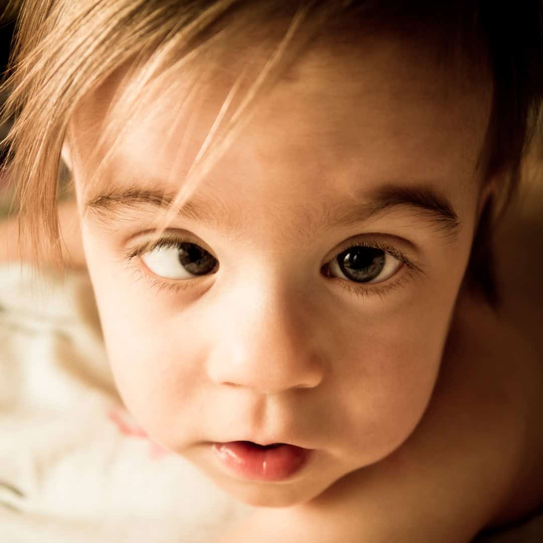 estrabismo en niños