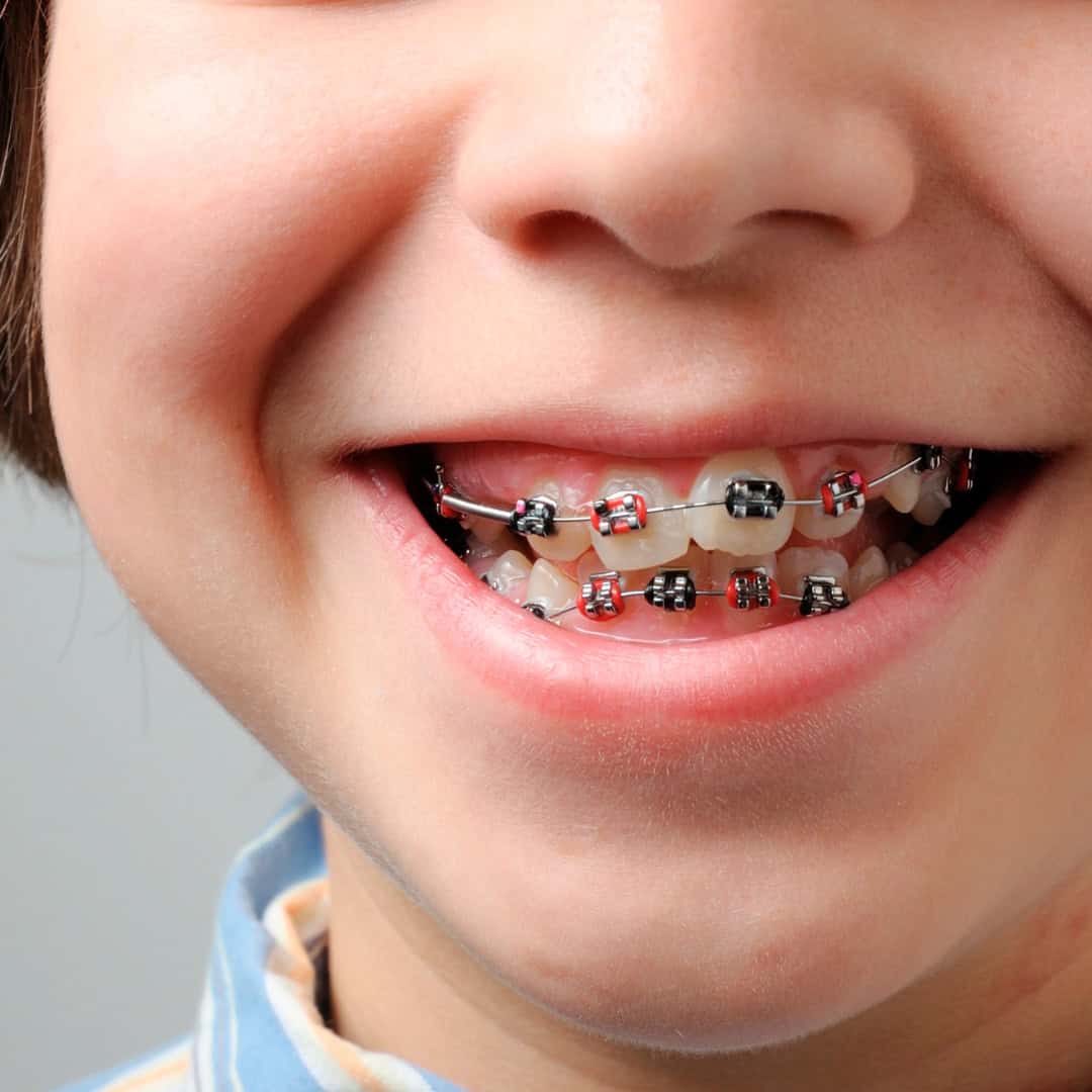 Ortodoncia en niños