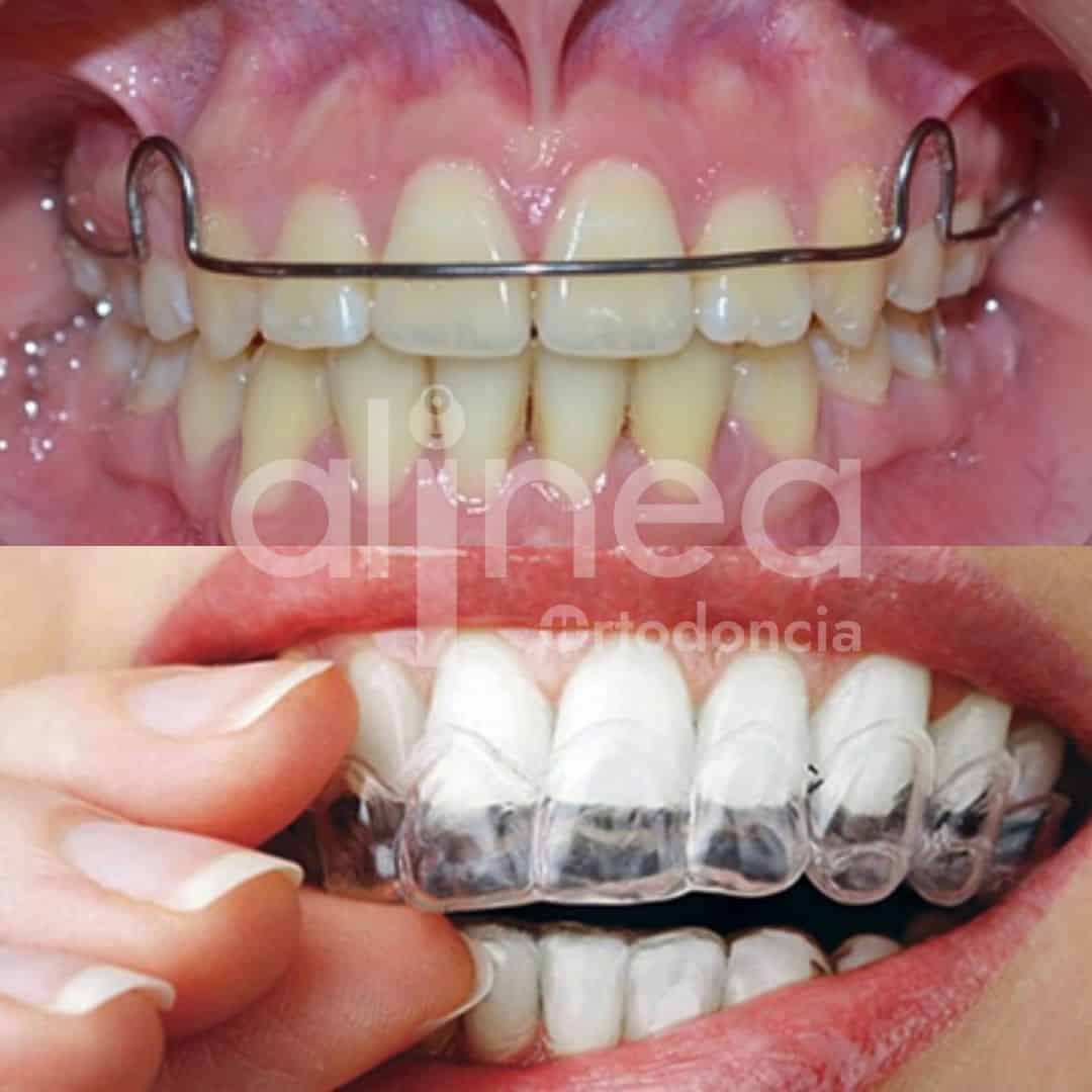Retenedores - Alinea Ortodoncia