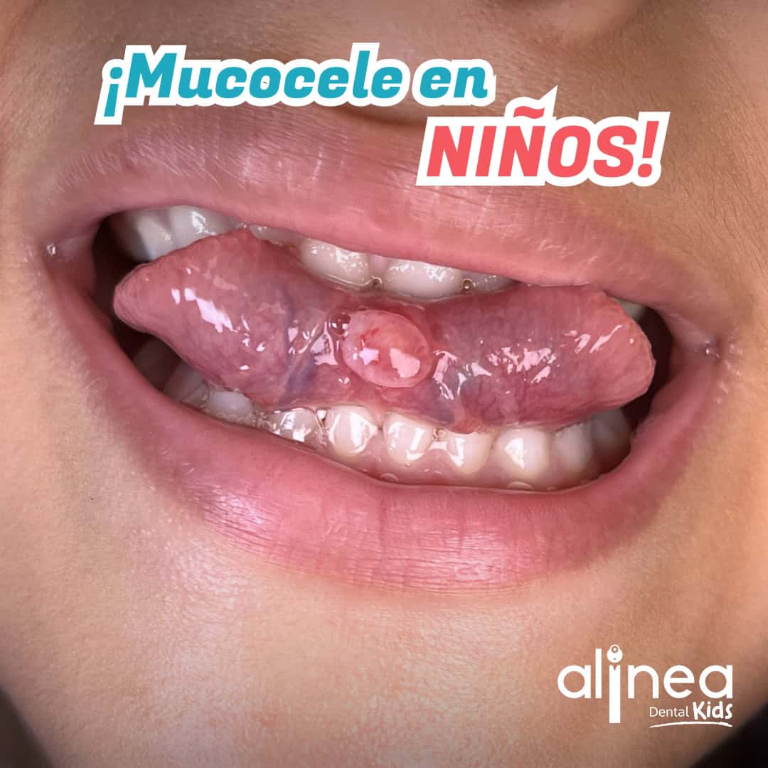 Mucocele - Dra Carolina Cuadros